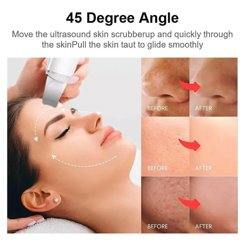 Limpiador facial espátula quita espinillas ULTRASONIDO